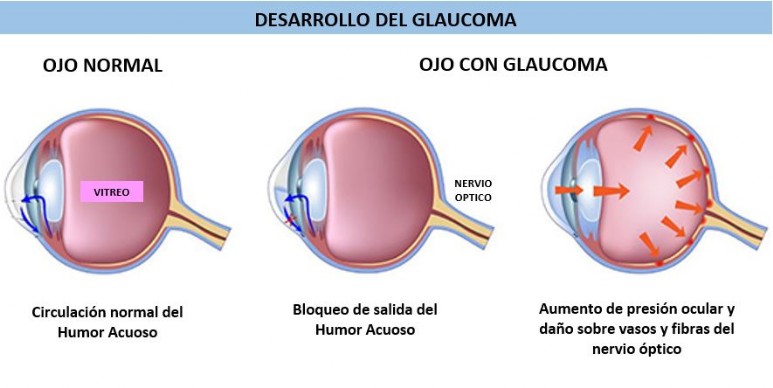 Glaucoma Centro Oftalmológico Dr Medín Catoira