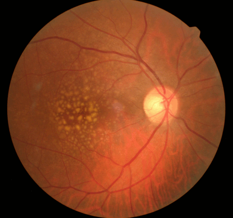 Degeneración Macular Asociada a la Edad (DMAE): Guía para entender, prevenir y tratar esta afección ocular